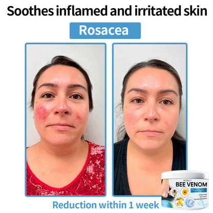 Seurico™ Bee Venom Multi-Symptom Skin Treatment Cream – Recommended by NPF for Targeted Skin Relief 🐝👨‍⚕️