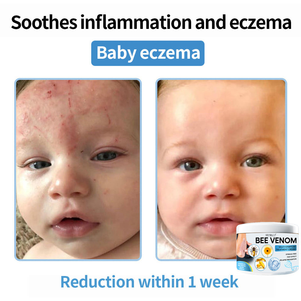 Seurico™ Bee Venom Multi-Symptom Skin Treatment Cream – Recommended by NPF for Targeted Skin Relief 🐝👨‍⚕️