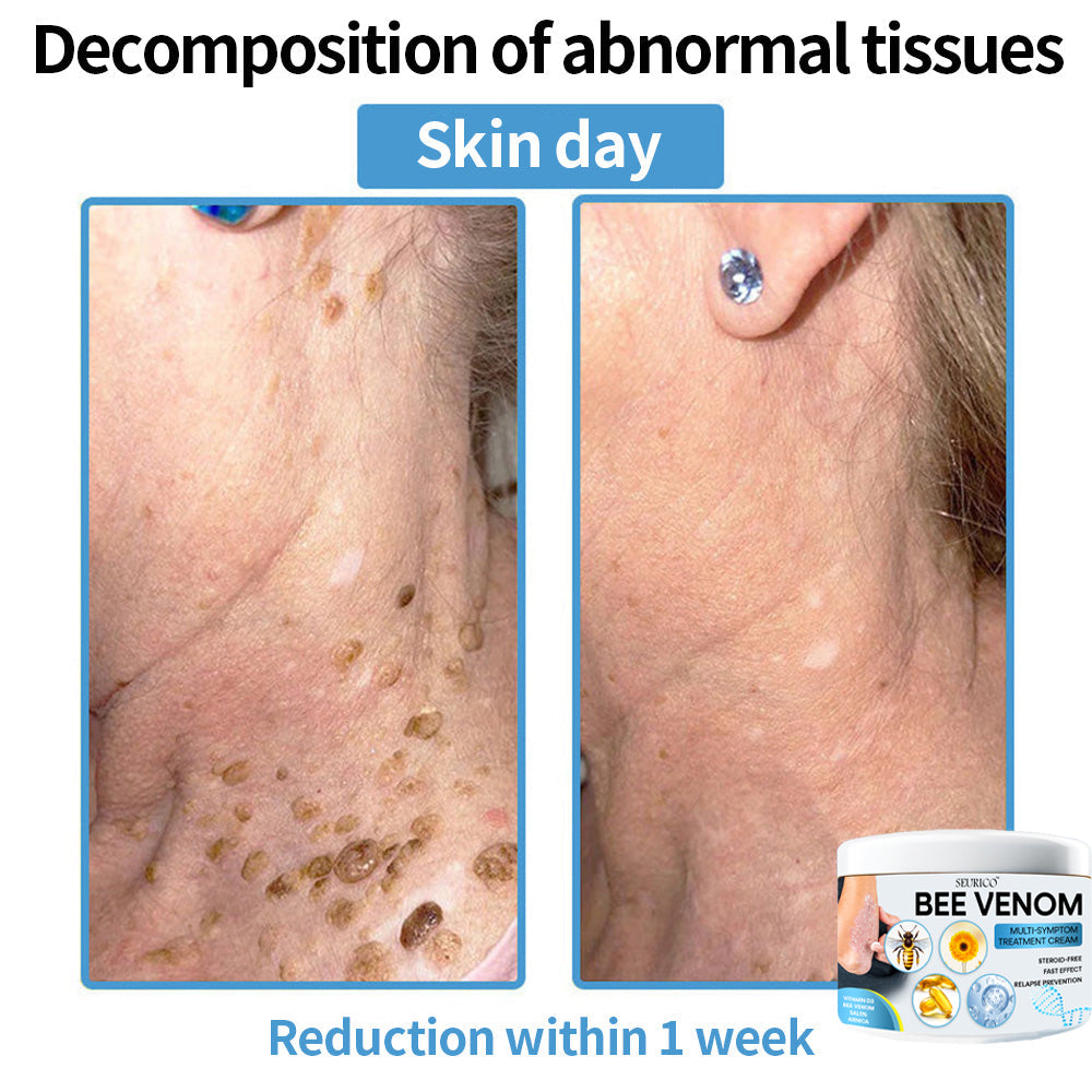 Seurico™ Bee Venom Multi-Symptom Skin Treatment Cream – Recommended by NPF for Targeted Skin Relief 🐝👨‍⚕️