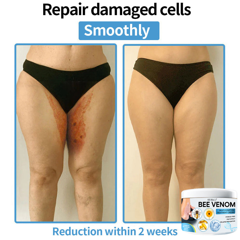 Seurico™ Bee Venom Multi-Symptom Skin Treatment Cream – Recommended by NPF for Targeted Skin Relief 🐝👨‍⚕️