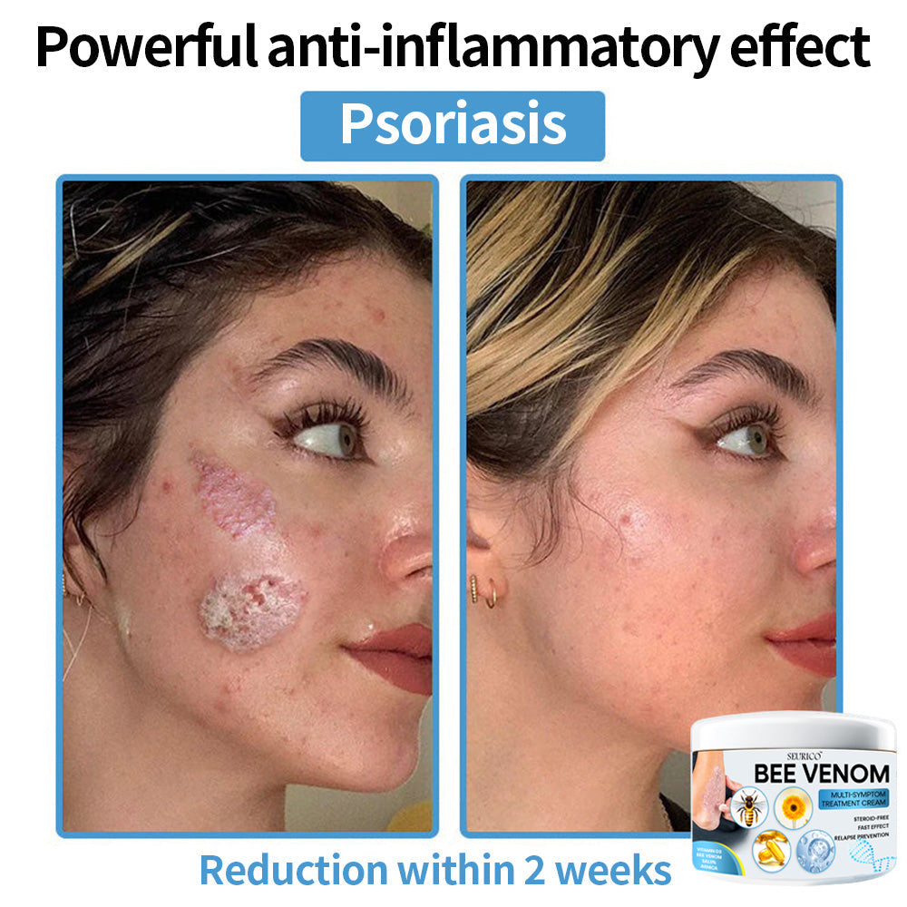 Seurico™ Bee Venom Multi-Symptom Skin Treatment Cream – Recommended by NPF for Targeted Skin Relief 🐝👨‍⚕️