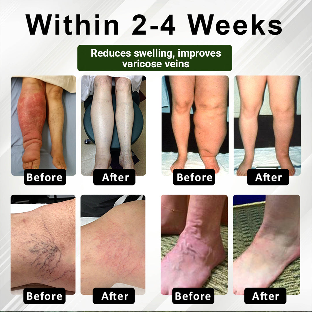 🏆ODEIUN™ CircuHerb Edema Soothing & Healing Balm | Instant Swelling Soothing • Vascular Care • Herbal Recovery ✨