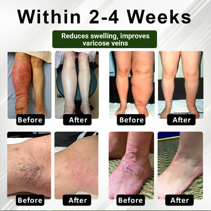 🏆ODEIUN™ CircuHerb Edema Soothing & Healing Balm | Instant Swelling Soothing • Vascular Care • Herbal Recovery ✨