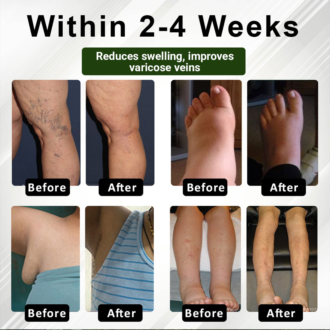 🏆ODEIUN™ CircuHerb Edema Soothing & Healing Balm | Instant Swelling Soothing • Vascular Care • Herbal Recovery ✨