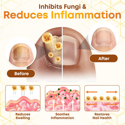 Negusy™ Bee Venom Nail Renewal Spray—Finish onychomycosis in 28 days! One spray restores healthy nails! 🦶 Effective for yellow, thick, brittle nails