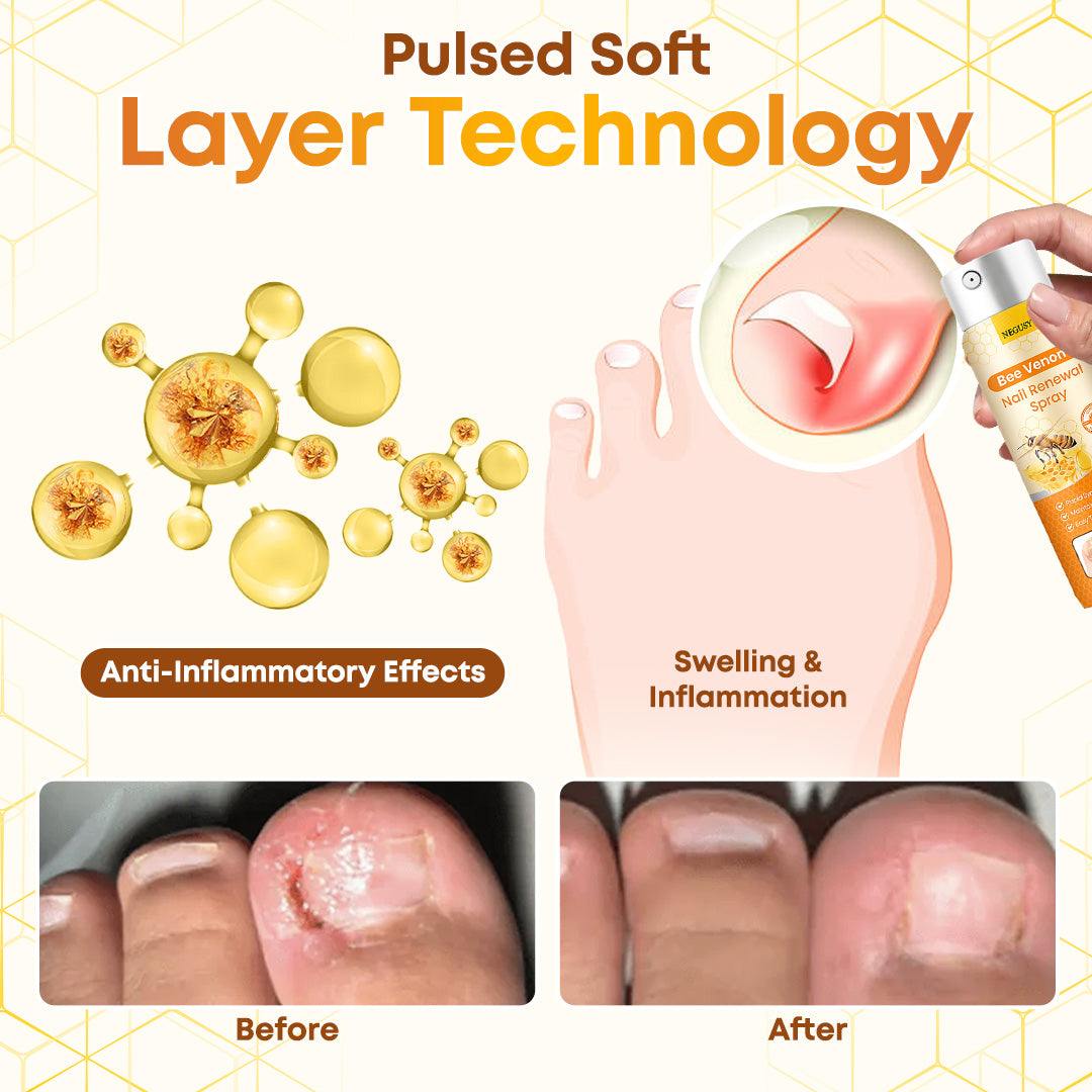 Negusy™ Bee Venom Nail Renewal Spray—Finish onychomycosis in 28 days! One spray restores healthy nails! 🦶 Effective for yellow, thick, brittle nails
