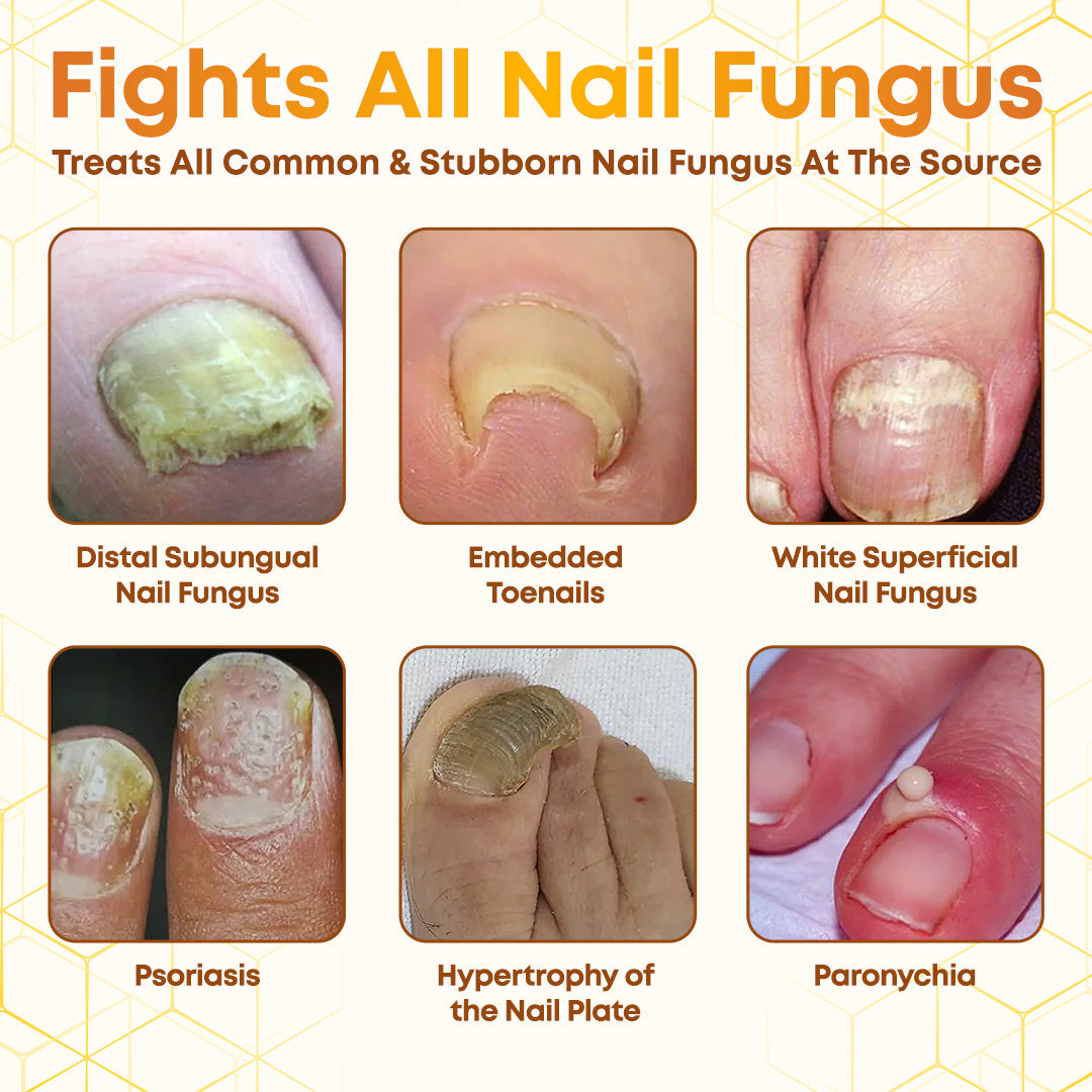 Negusy™ Bee Venom Nail Renewal Spray—Finish onychomycosis in 28 days! One spray restores healthy nails! 🦶 Effective for yellow, thick, brittle nails