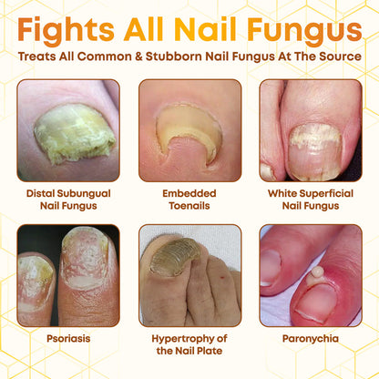 Negusy™ Bee Venom Nail Renewal Spray—Finish onychomycosis in 28 days! One spray restores healthy nails! 🦶 Effective for yellow, thick, brittle nails