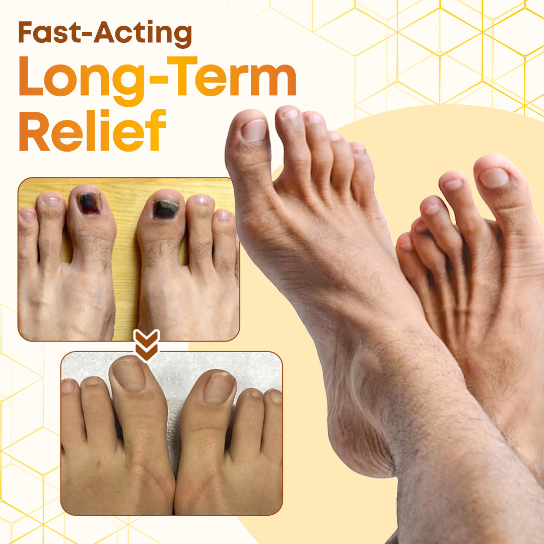 Negusy™ Bee Venom Nail Renewal Spray—Finish onychomycosis in 28 days! One spray restores healthy nails! 🦶 Effective for yellow, thick, brittle nails