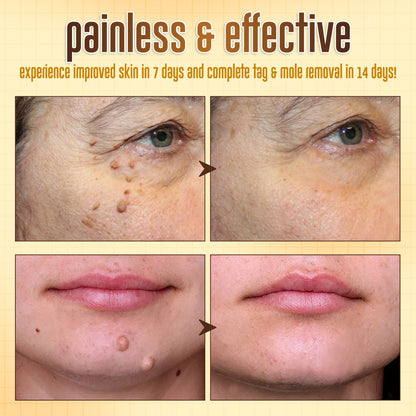 ✨ ODEIUN™ BeeDerm RX Cream – Natural Wart, Mole & Skin Tag Remover with Healing Bee Venom